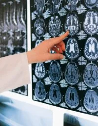 brain_1625958832-scaled-199x298x0x21x199x255x1687242220 Brain scans